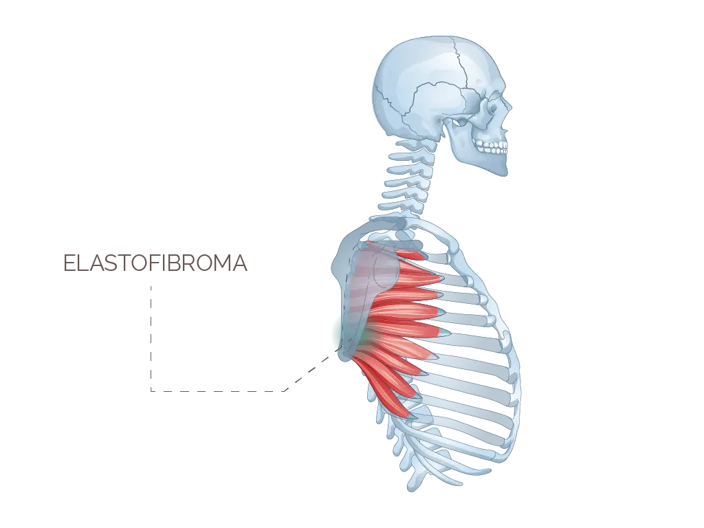 dove operare elastofibroma