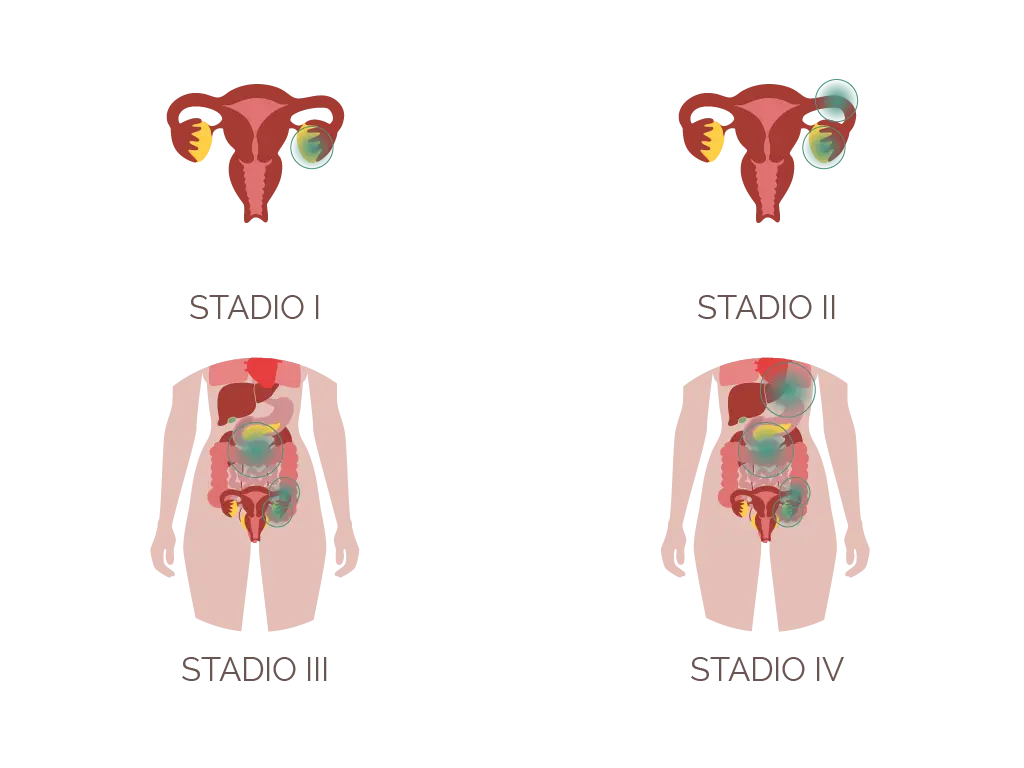 tumore ovaio in quanto tempo si sviluppa