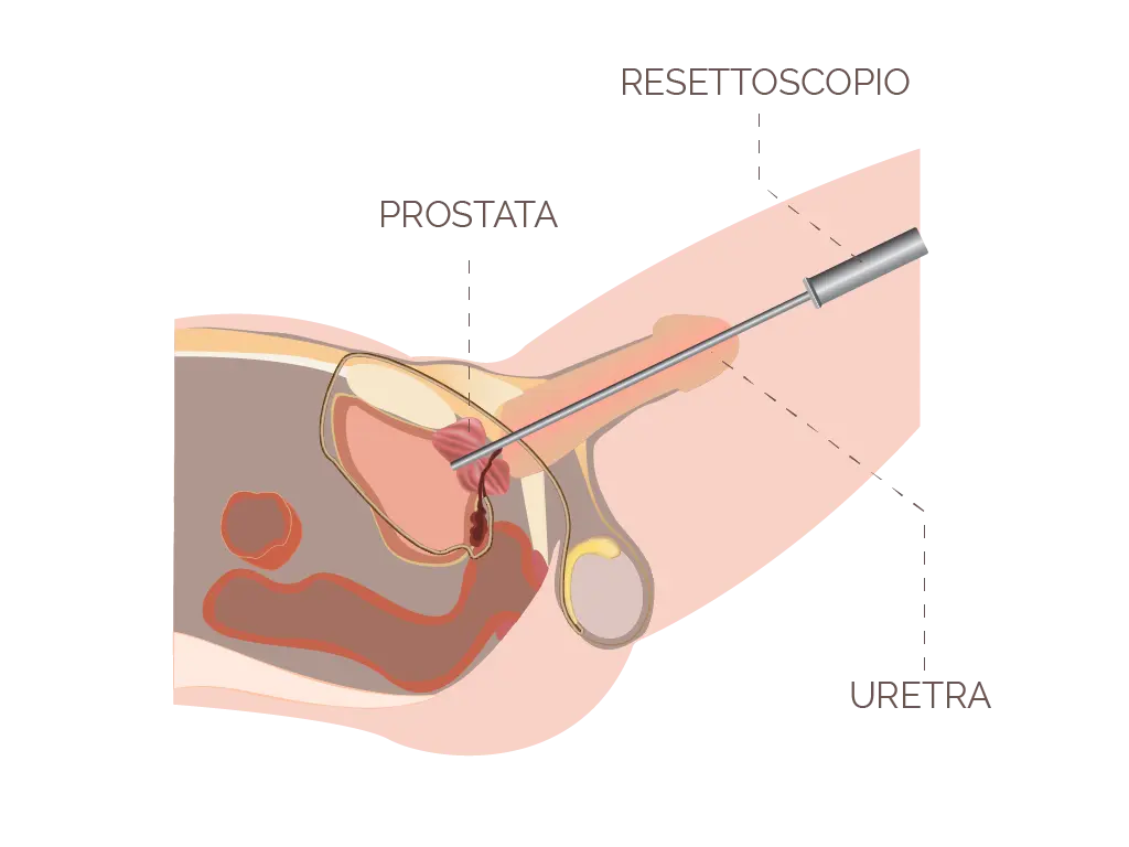 turp prostata